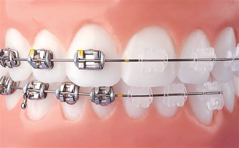 brackets porcelana vs metal|ceramic braces vs metal brackets.